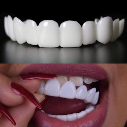 لمینت دندان دو فک مدل Snap on Smile